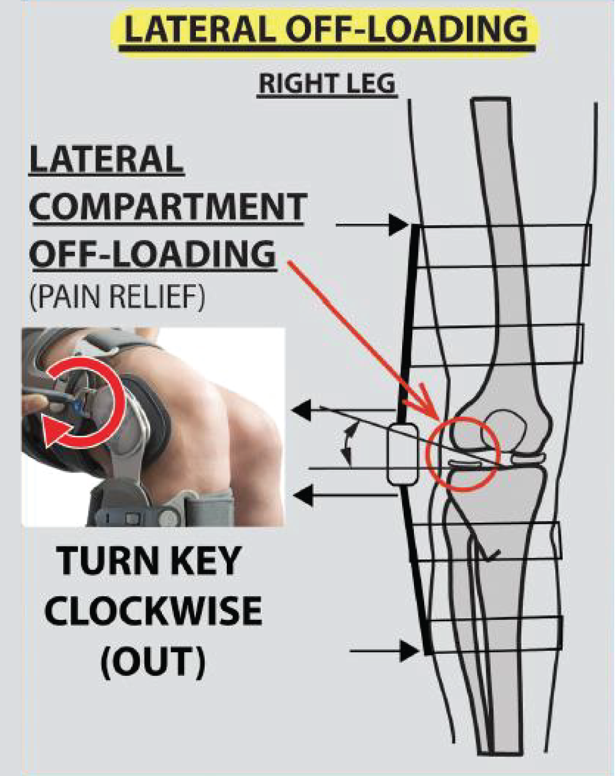 Ovation Medical Game Changer Universal OA Premium Knee Brace Left New